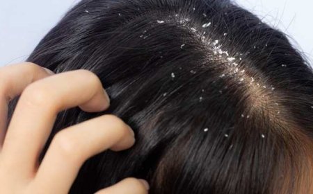 ತಲೆ ತುಂಬಾ ಹೊಟ್ಟಾಗಿ ತುರಿಸ್ತಾ ಇದ್ಯಾ? ಈ ಮನೆಮದ್ದನ್ನು ಫಾಲೋ ಮಾಡಿದ್ರೆ ಪಕ್ಕಾ ರಿಸಲ್ಟ್