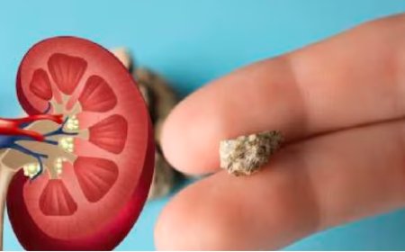 Kidney Stones: ಕಿಡ್ನಿಯಲ್ಲಿ ಕಲ್ಲು ಇದ್ರೆ ಈ ಆಹಾರಗಳನ್ನು ಅಪ್ಪಿ ತಪ್ಪಿ ತಿನ್ನಲೇಬೇಡಿ..!