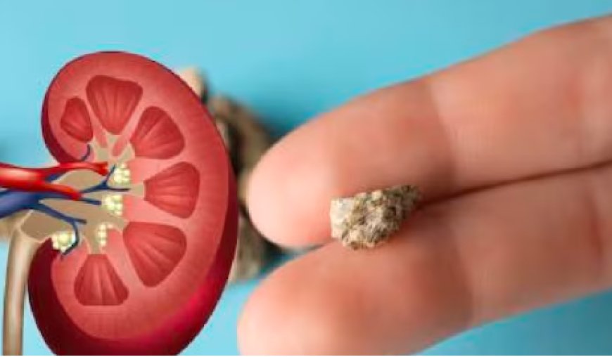 Kidney Stones: ಕಿಡ್ನಿಯಲ್ಲಿ ಕಲ್ಲು ಇದ್ರೆ ಈ ಆಹಾರಗಳನ್ನು ಅಪ್ಪಿ ತಪ್ಪಿ ತಿನ್ನಲೇಬೇಡಿ..!