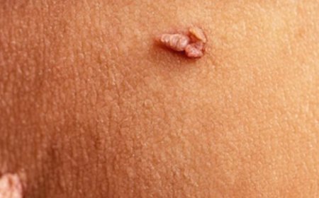 ಈ ನರಹುಲಿ ಸಮಸ್ಯೆ ನಿಮಗೆ ಹೆಚ್ಚಾಗಿದೆಯಾ? ಹಾಗಿದ್ರೆ ಈ ಸರಳ ಮನೆಮದ್ದುಗಳು ಫಾಲೋ ಮಾಡಿ